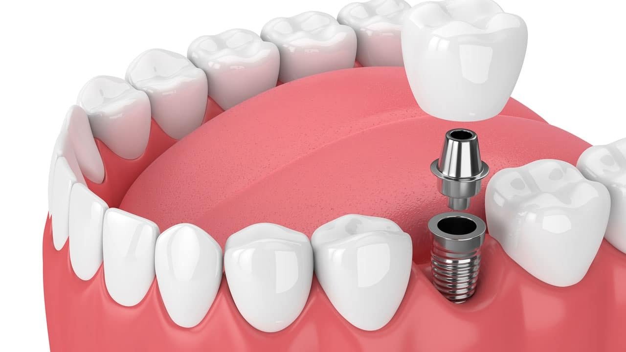 Dental implants - the most emerging option in cosmetic makeover and teeth restoration in Mumbai