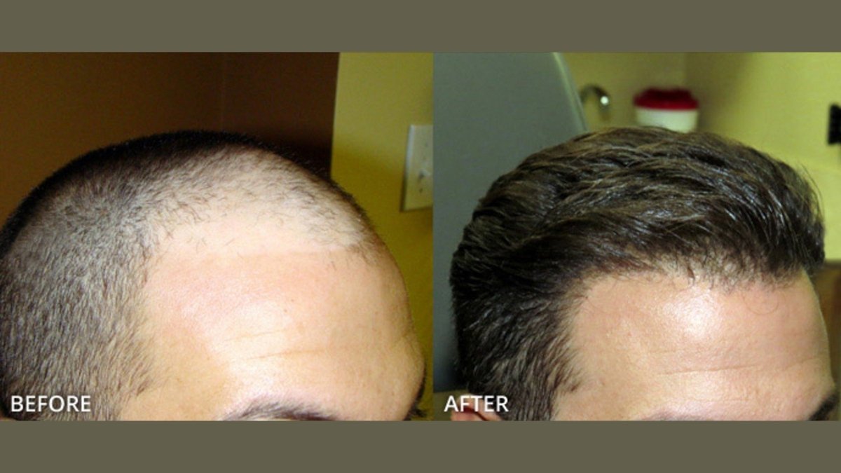 Affordable and Advanced FUE Hair Transplant treatments with promising results