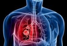 Lung Illness