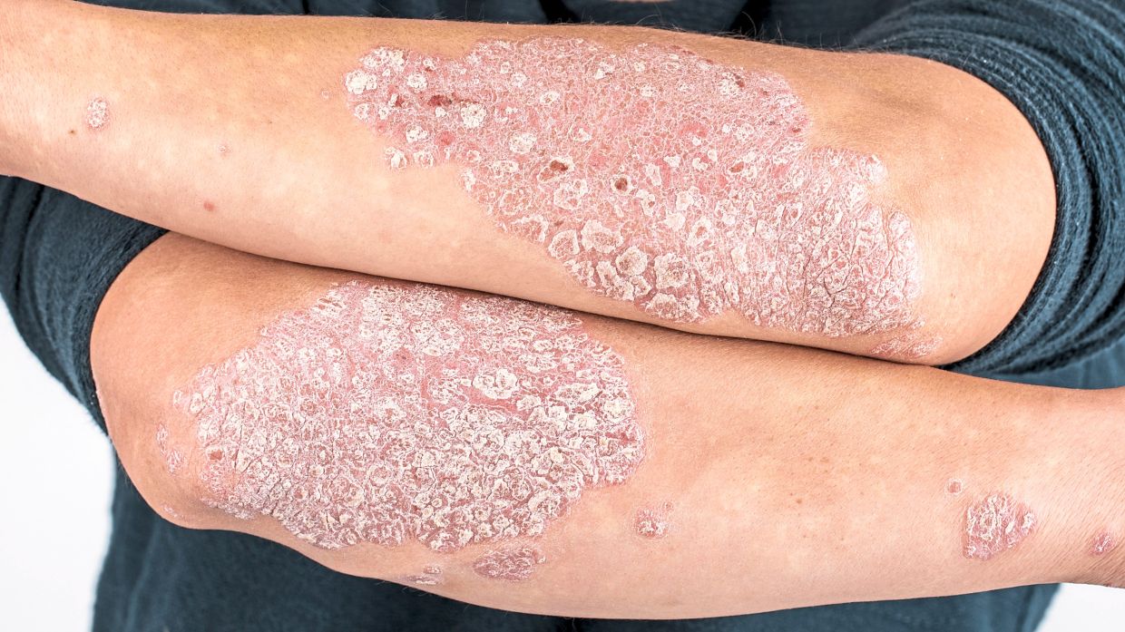 World Psoriasis Day- Many Myths associated with Psoriasis
