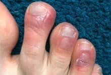 COVID Toes condition that causes purple rashes in patients’ toes prompts medical attention