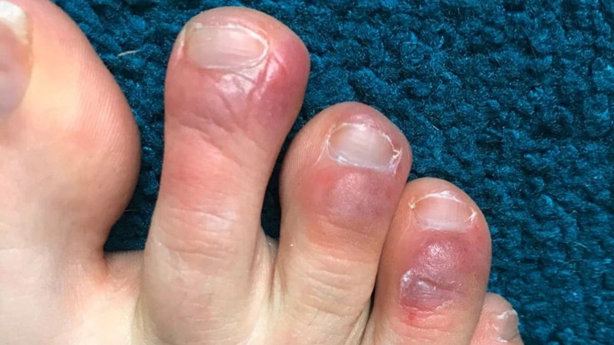 COVID Toes condition that causes purple rashes in patients’ toes prompts medical attention