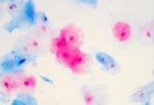 HPV immunization program has almost eradicated Cervical Cancer in women-Lancet Study