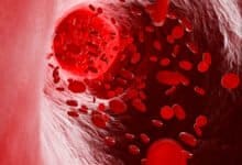 How effective will the move of fortifying Rice with Iron in reducing the incidence of Anaemia