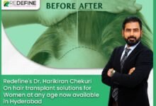 Redefine DR Harikiran Chekuri on hair transplant solutions for women at any age now available in Hyderabad