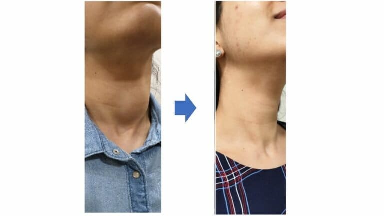 Surgeons across adopt the RABIT technique of robotic thyroidectomy ...