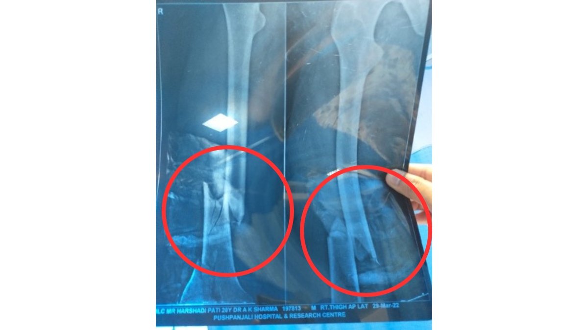 AEN Harshadipati thigh bone cracked by MLA Malinga 
